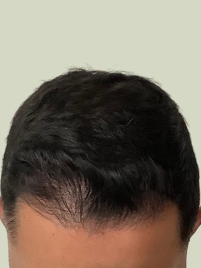 FUE Hair Transplant Before & After Gallery - Patient 177685 - Image 2