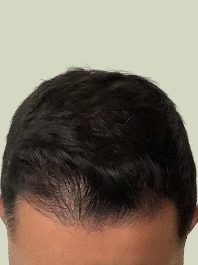 Male Hair Transplants Before & After Gallery - Patient 275974 - Image 2