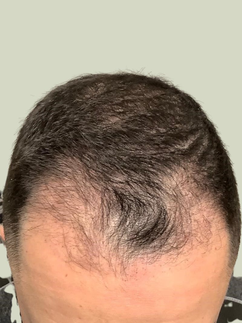 Male Hair Transplants Before & After Gallery - Patient 275974 - Image 1