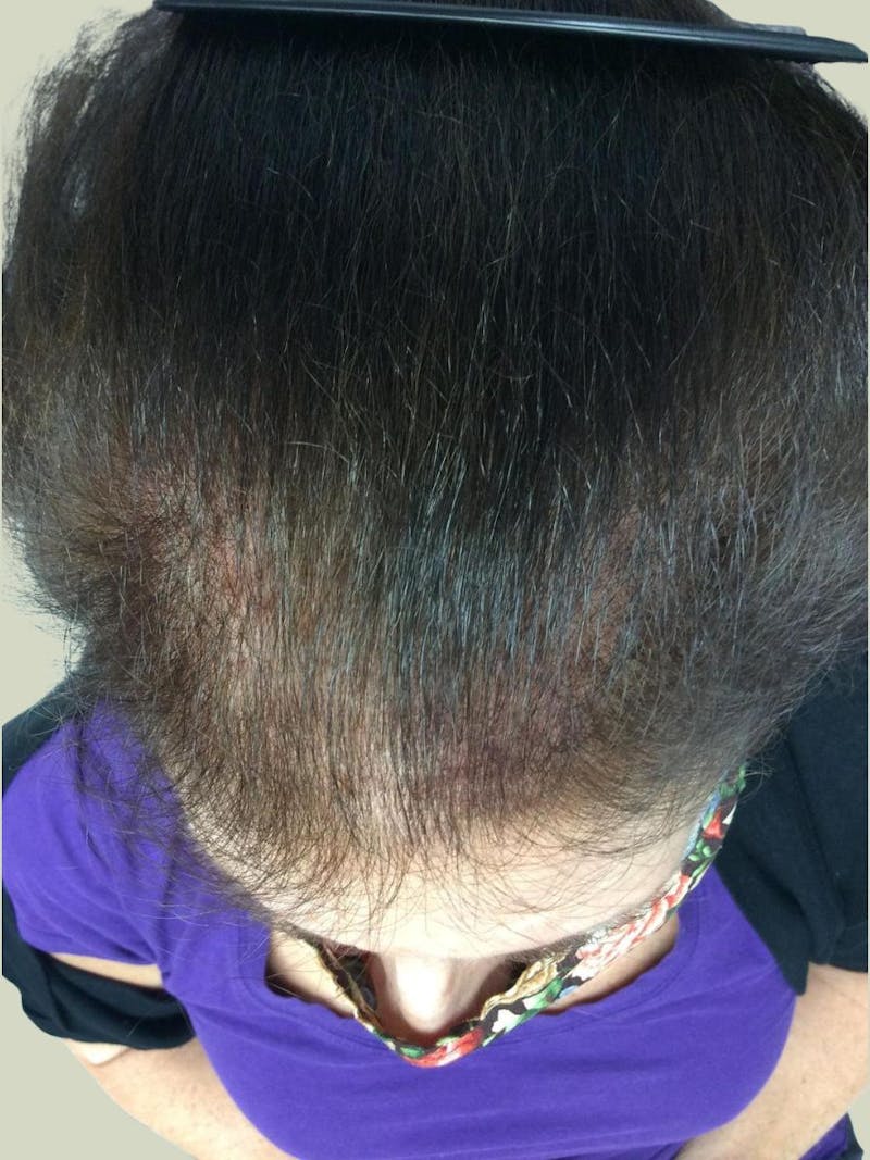 Low Level Laser Therapy Before & After Gallery - Patient 274573 - Image 1