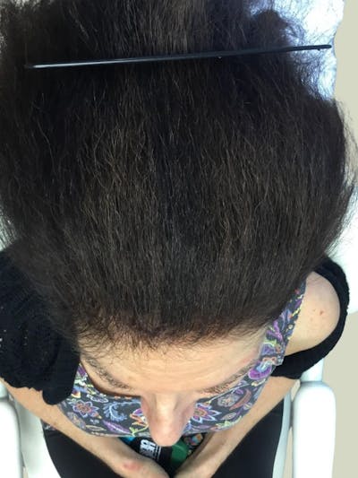 Painless PRP Before & After Gallery - Patient 142019 - Image 2