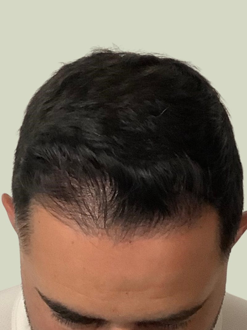 Male Hair Transplants Before & After Gallery - Patient 209891 - Image 2