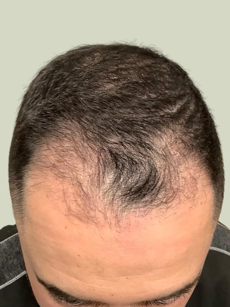 Male Hair Transplants Before & After Gallery - Patient 209891 - Image 1