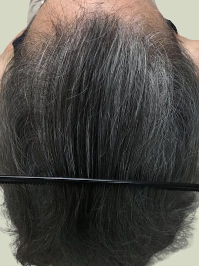 Painless PRP Before & After Gallery - Patient 131626 - Image 2