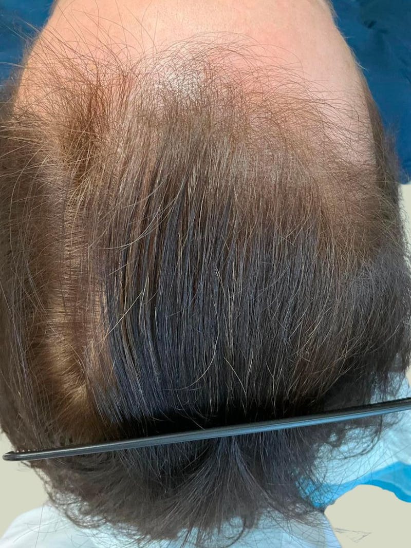 Painless PRP Before & After Gallery - Patient 131626 - Image 1
