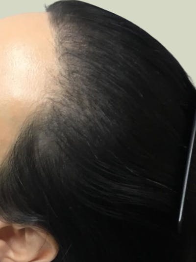Painless PRP Before & After Gallery - Patient 380891 - Image 2