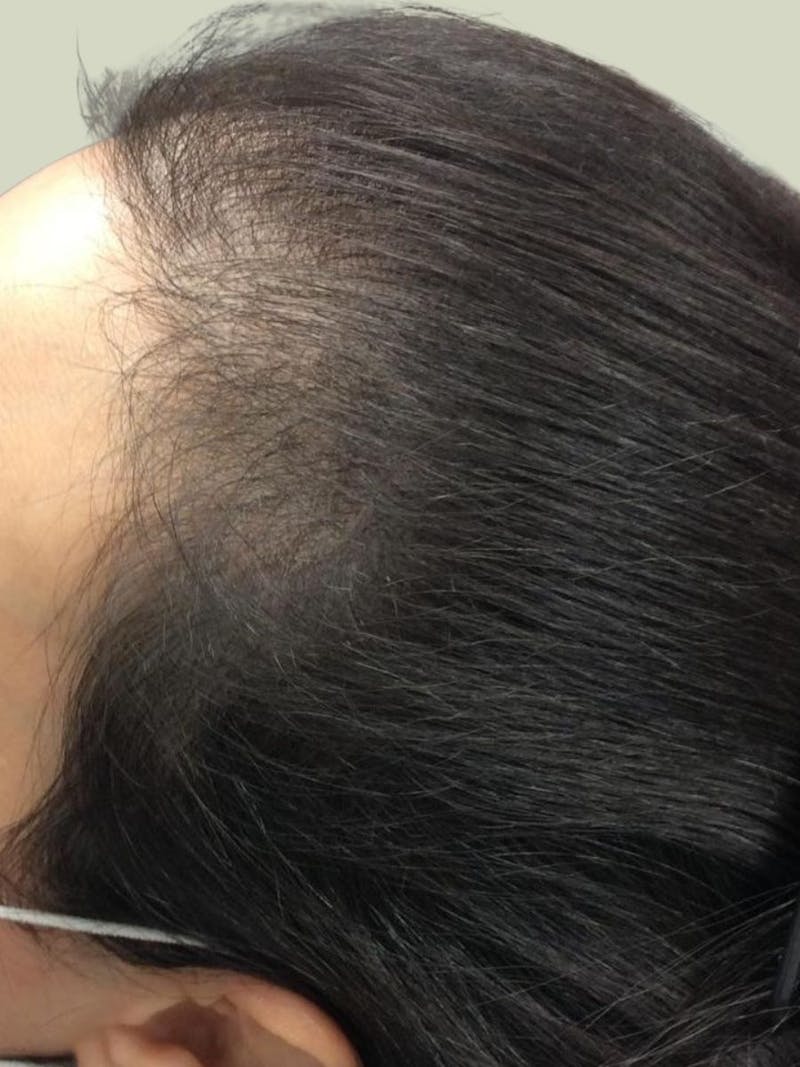 Androgenic Alopecia Before & After Gallery - Patient 347304 - Image 1