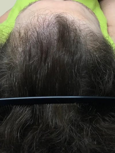 Optimal Platelet Concentration™ Therapy Before & After Gallery - Patient 198542 - Image 2