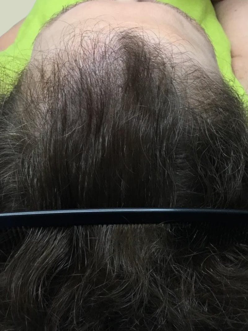 Optimal Platelet Concentration™ Therapy Before & After Gallery - Patient 198542 - Image 2