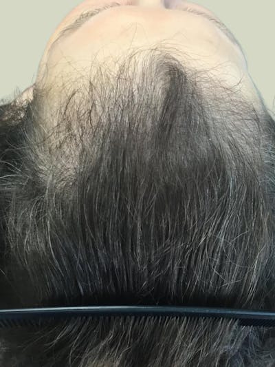 Optimal Platelet Concentration™ Therapy Before & After Gallery - Patient 198542 - Image 1