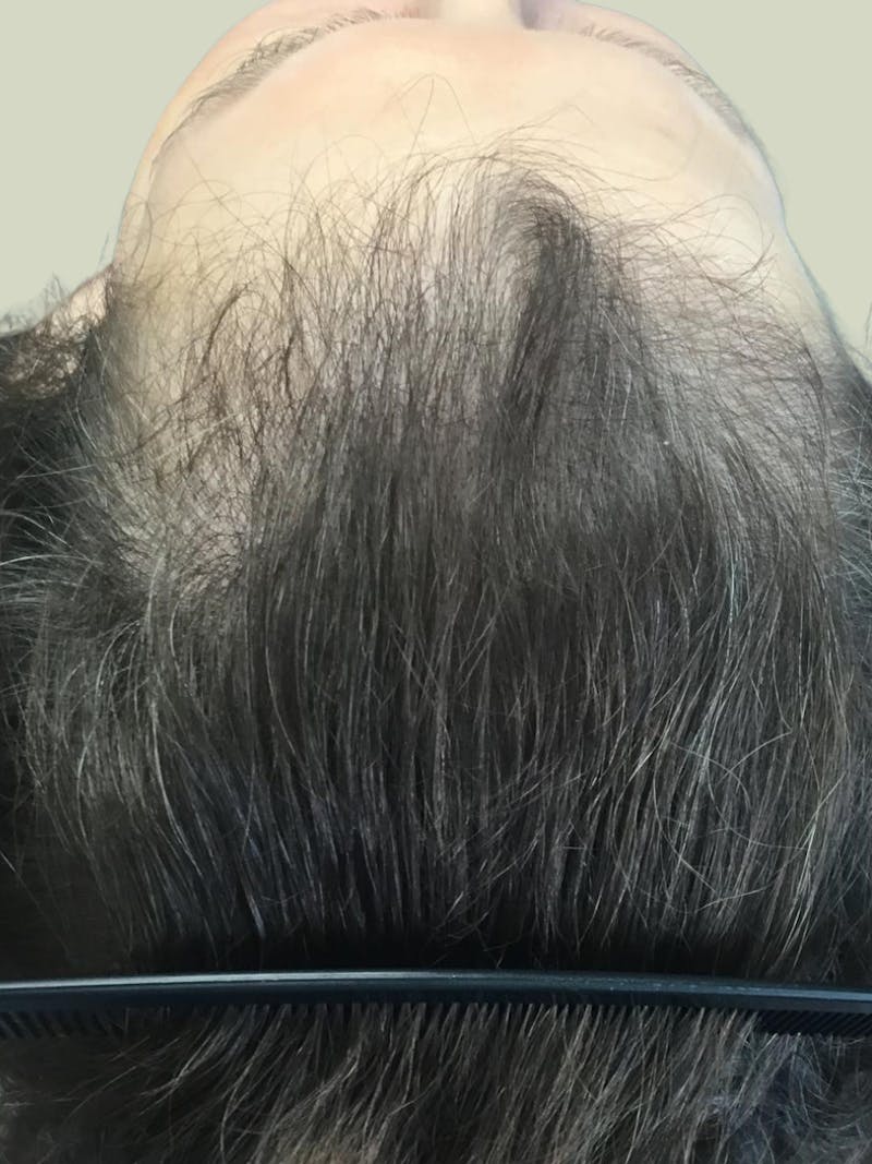 Optimal Platelet Concentration™ Therapy Before & After Gallery - Patient 198542 - Image 1