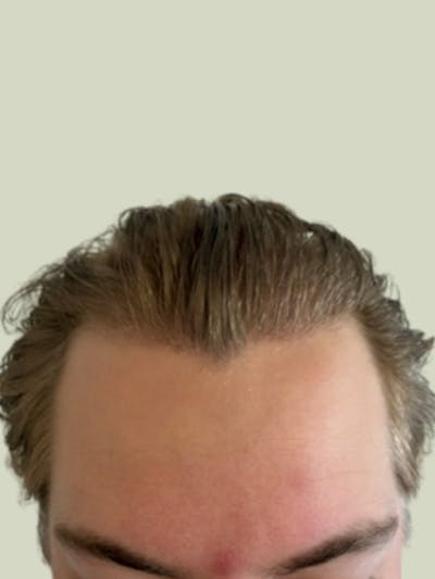 FUE Hair Transplant Before & After Gallery - Patient 260863 - Image 2