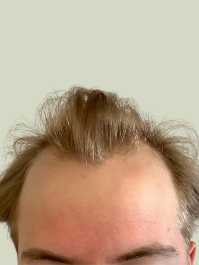 FUE Hair Transplant Before & After Gallery - Patient 260863 - Image 1