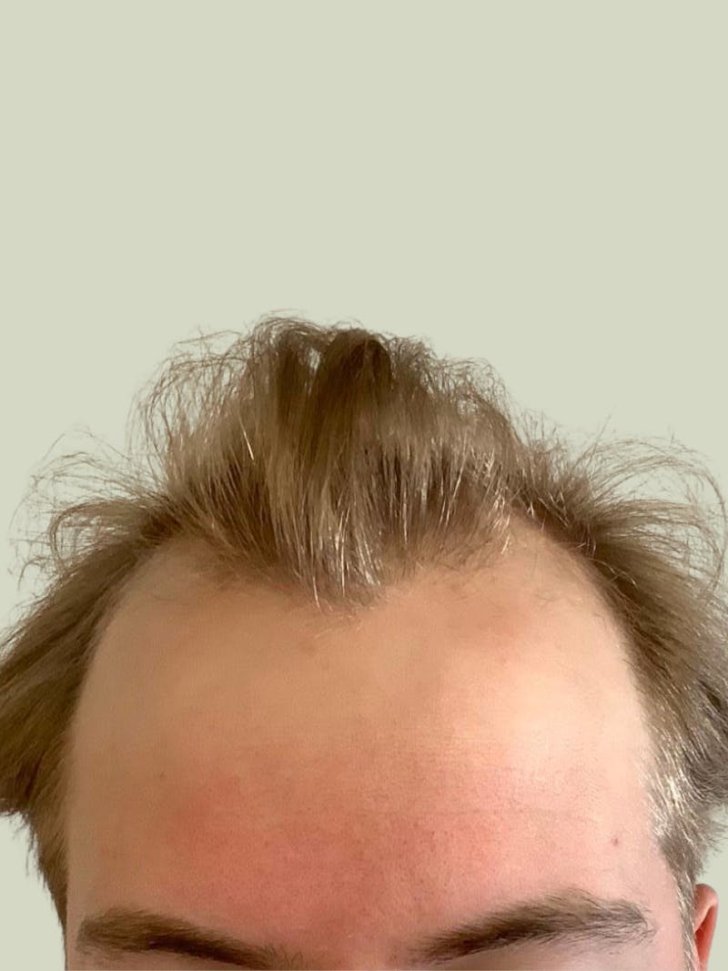 FUE Hair Transplant Before & After Gallery - Patient 260863 - Image 1