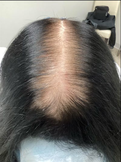 Androgenic Alopecia Before & After Gallery - Patient 304776 - Image 1