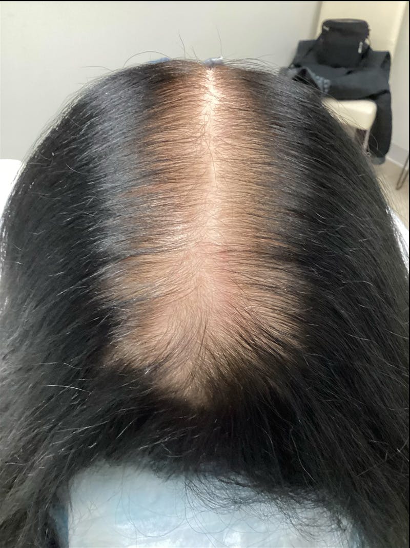 Androgenic Alopecia Before & After Gallery - Patient 304776 - Image 1