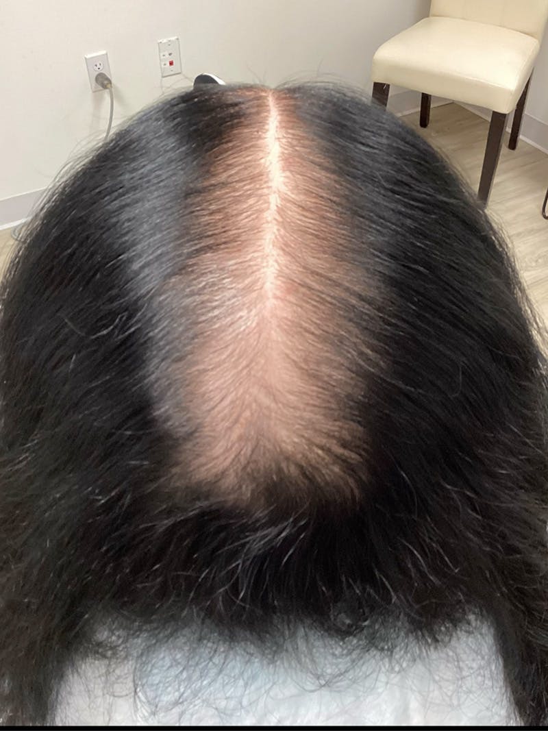 Androgenic Alopecia Before & After Gallery - Patient 304776 - Image 2