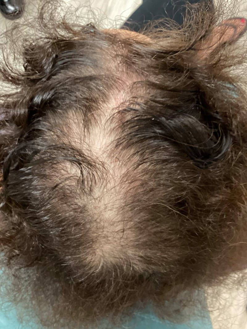 Androgenic Alopecia Before & After Gallery - Patient 336572 - Image 1
