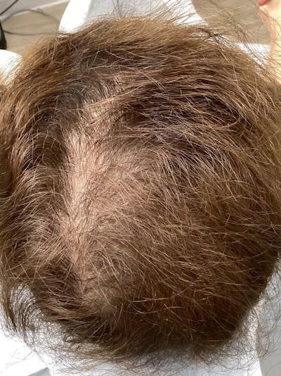 Androgenic Alopecia Before & After Gallery - Patient 336572 - Image 2