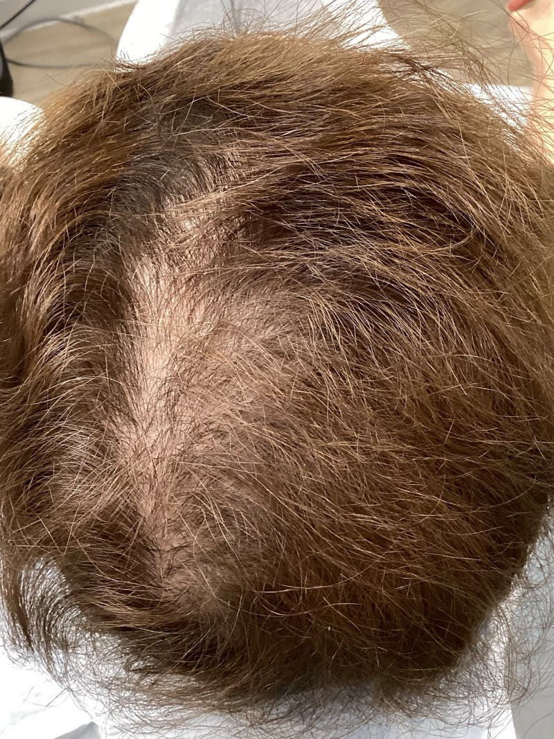 Androgenic Alopecia Before & After Gallery - Patient 336572 - Image 2