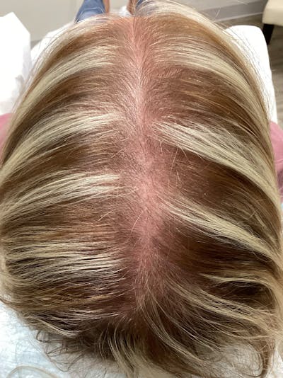 Androgenic Alopecia Before & After Gallery - Patient 374525 - Image 1