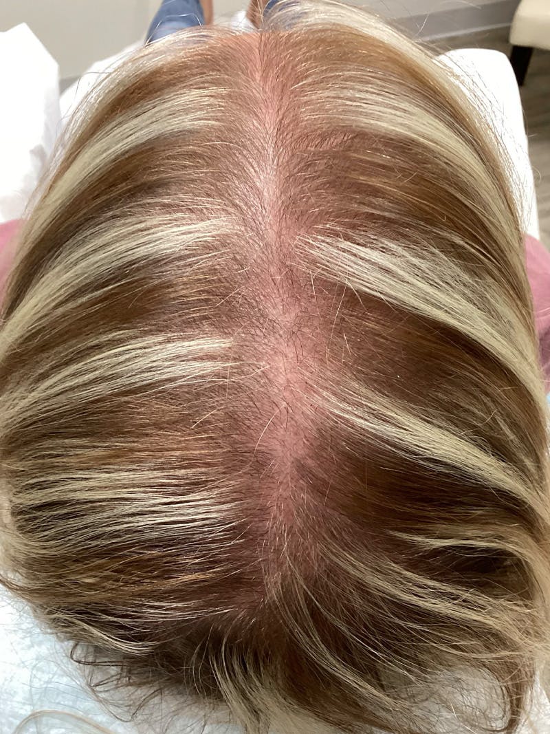 Androgenic Alopecia Before & After Gallery - Patient 374525 - Image 1