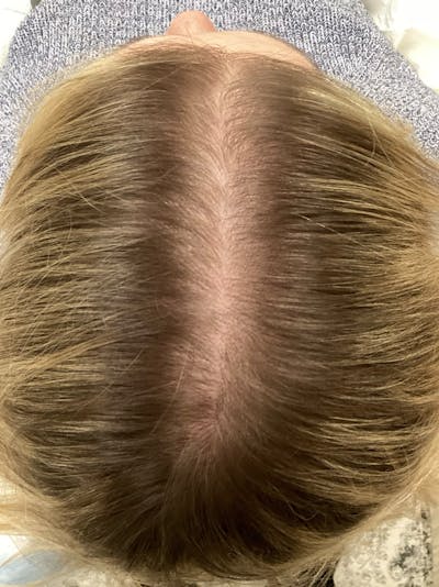 Androgenic Alopecia Before & After Gallery - Patient 374525 - Image 2