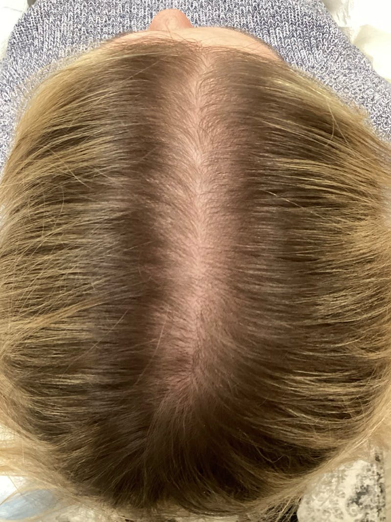 Androgenic Alopecia Before & After Gallery - Patient 374525 - Image 2