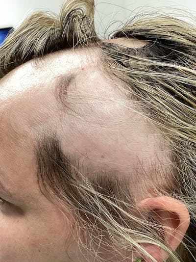 Alopecia Areata Before & After Gallery - Patient 528123 - Image 1