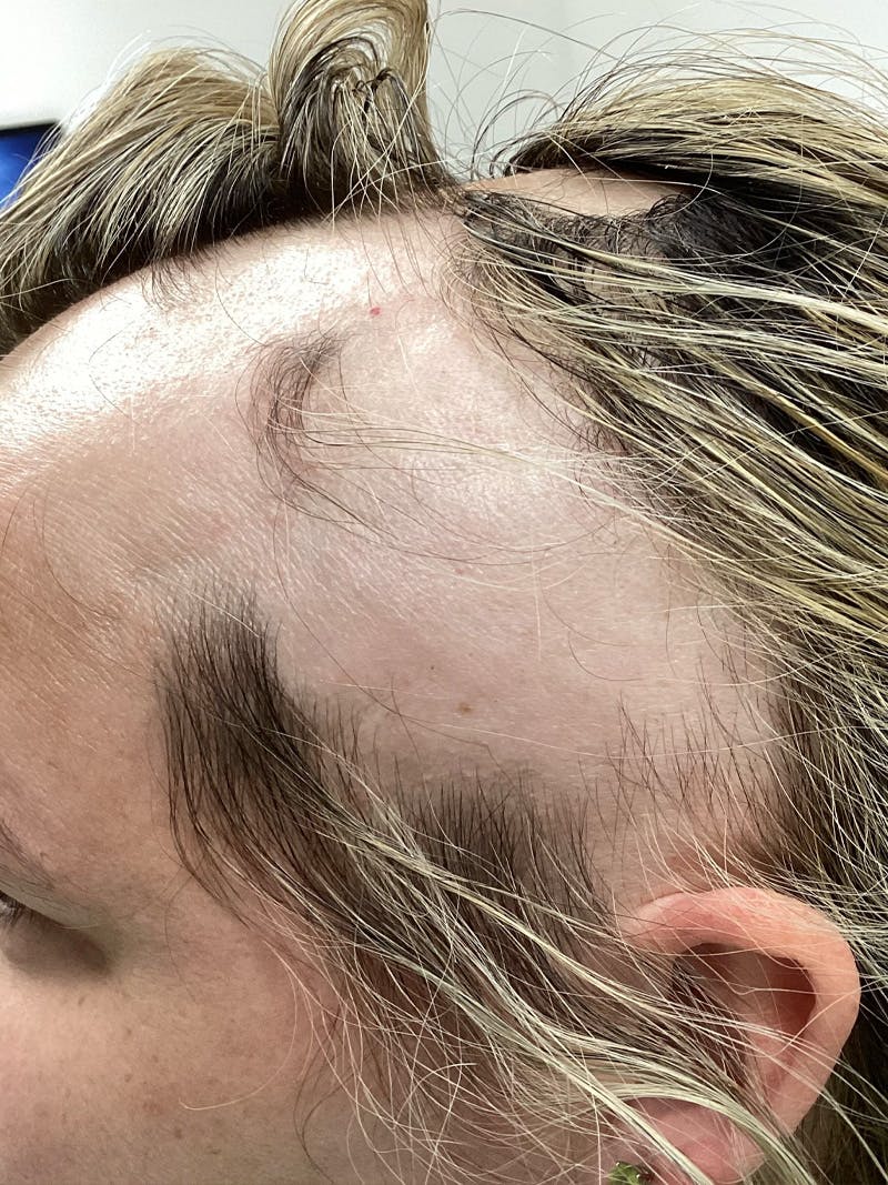 Androgenic Alopecia Before & After Gallery - Patient 153800 - Image 1