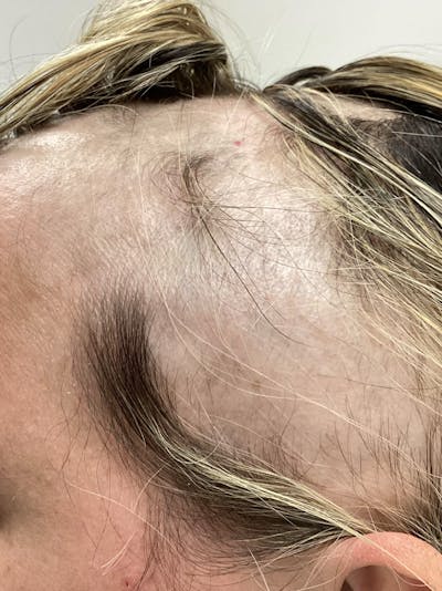 Alopecia Areata Before & After Gallery - Patient 528123 - Image 2
