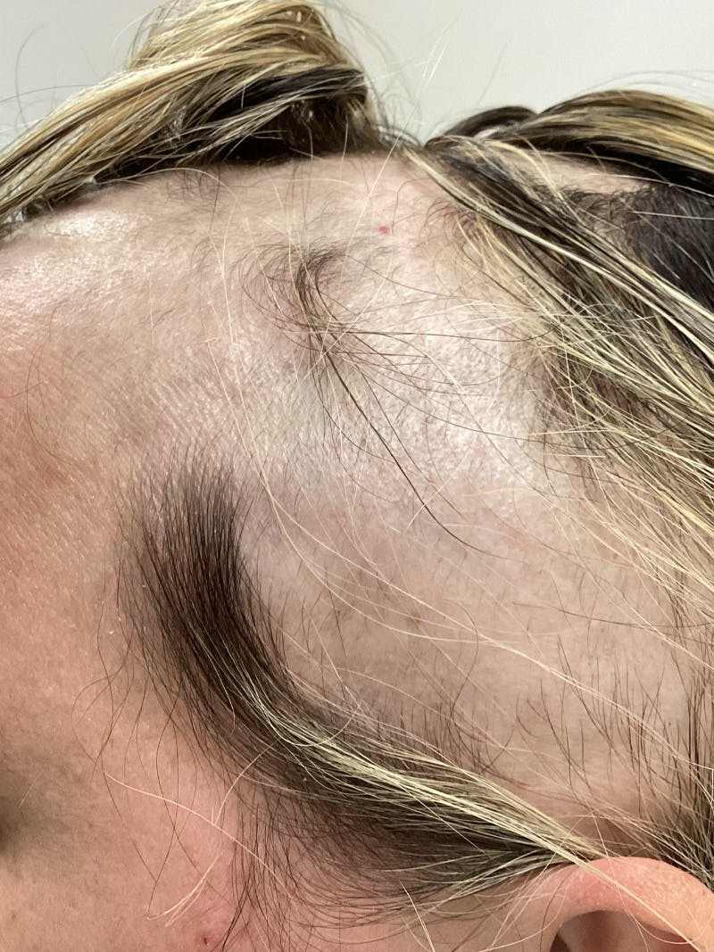 Androgenic Alopecia Before & After Gallery - Patient 153800 - Image 2