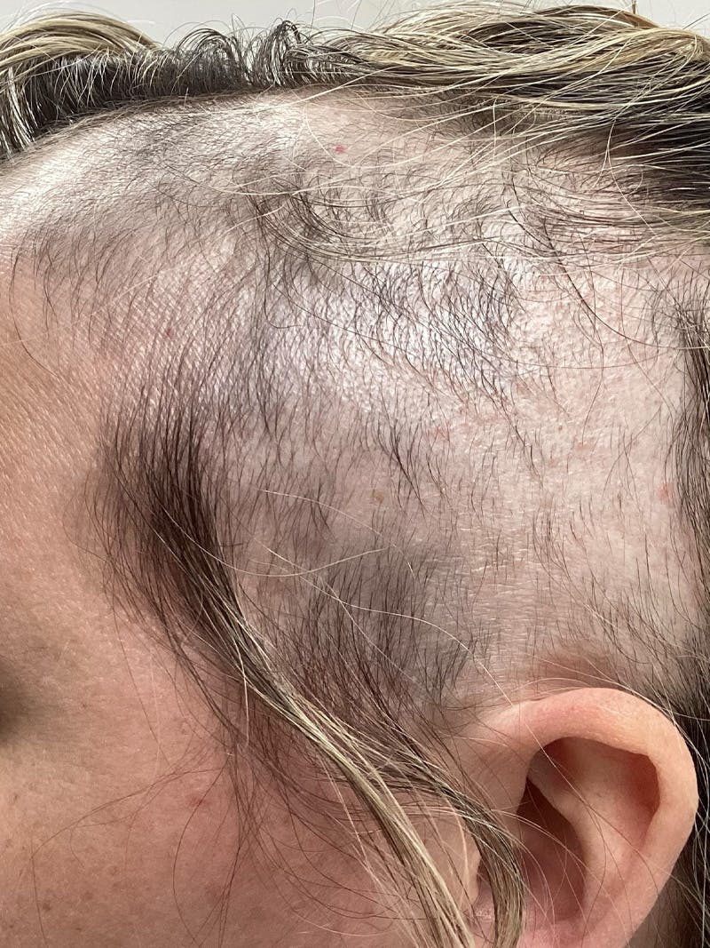 Androgenic Alopecia Before & After Gallery - Patient 153800 - Image 3