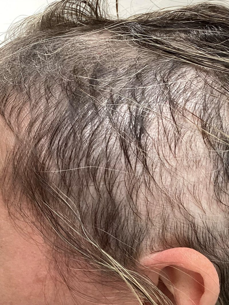 Androgenic Alopecia Before & After Gallery - Patient 153800 - Image 4