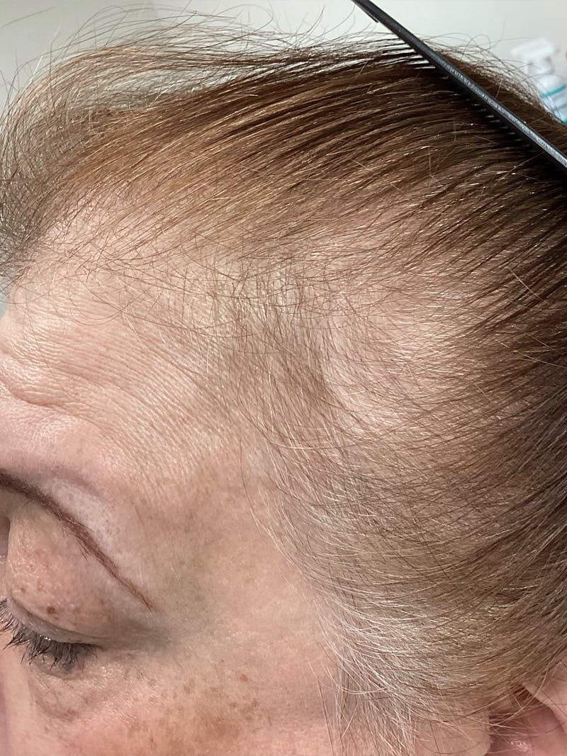 Androgenic Alopecia Before & After Gallery - Patient 260936 - Image 1