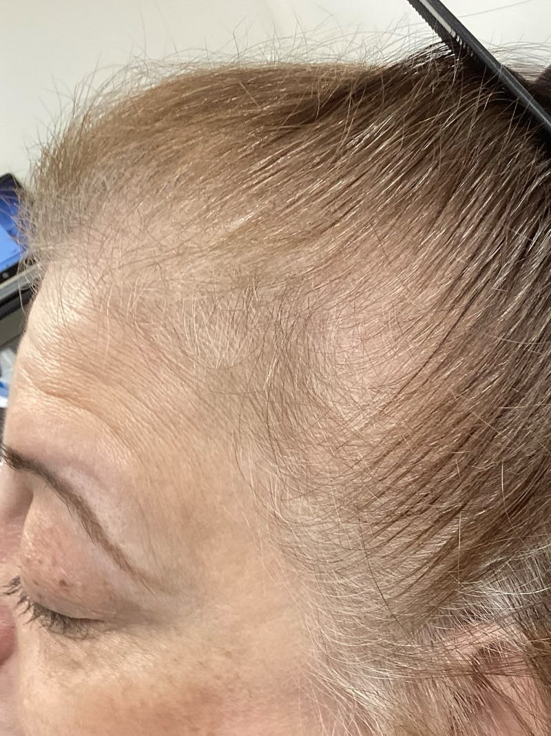Androgenic Alopecia Before & After Gallery - Patient 260936 - Image 2