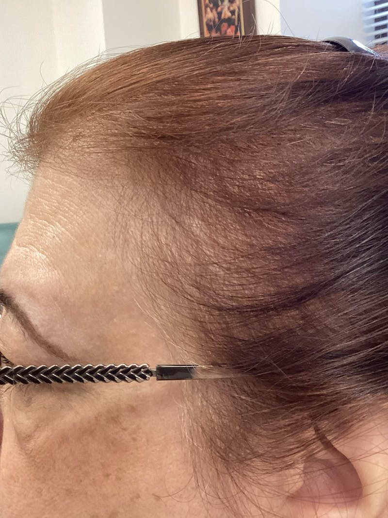 Androgenic Alopecia Before & After Gallery - Patient 260936 - Image 4