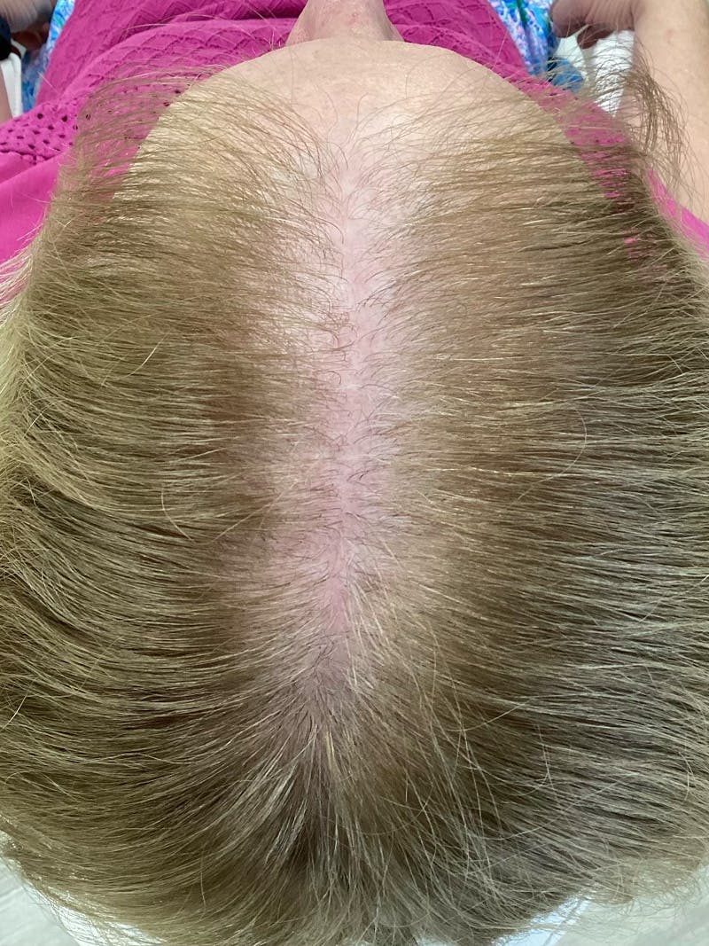 Scarring Alopecia Before & After Gallery - Patient 145556 - Image 1