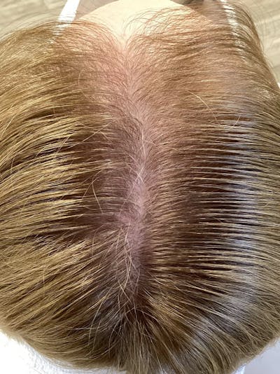 Scarring Alopecia Before & After Gallery - Patient 145556 - Image 2