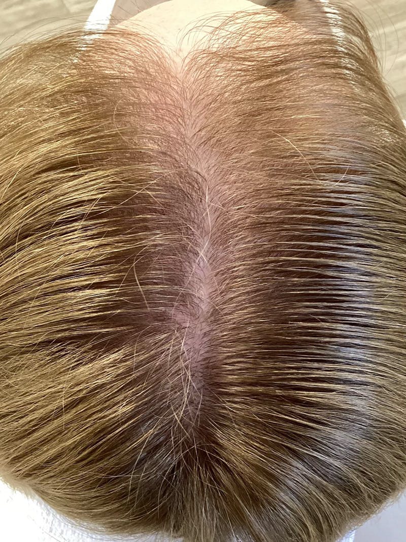 Scarring Alopecia Before & After Gallery - Patient 145556 - Image 2
