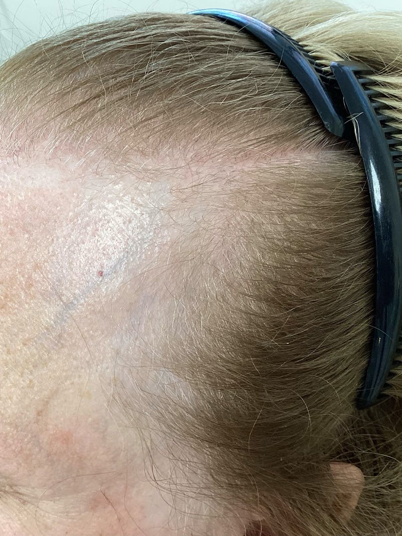 Scarring Alopecia Before & After Gallery - Patient 240849 - Image 1