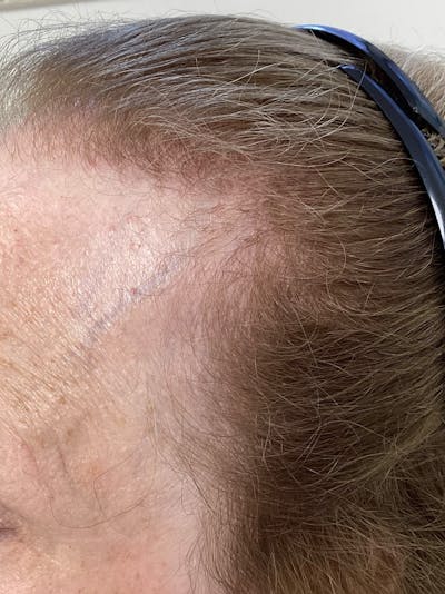 Scarring Alopecia Before & After Gallery - Patient 240849 - Image 2