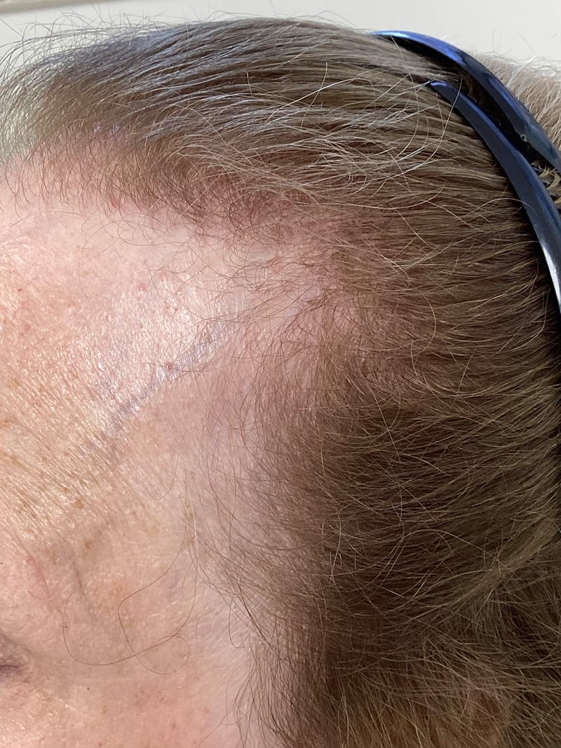 Scarring Alopecia Before & After Gallery - Patient 240849 - Image 2