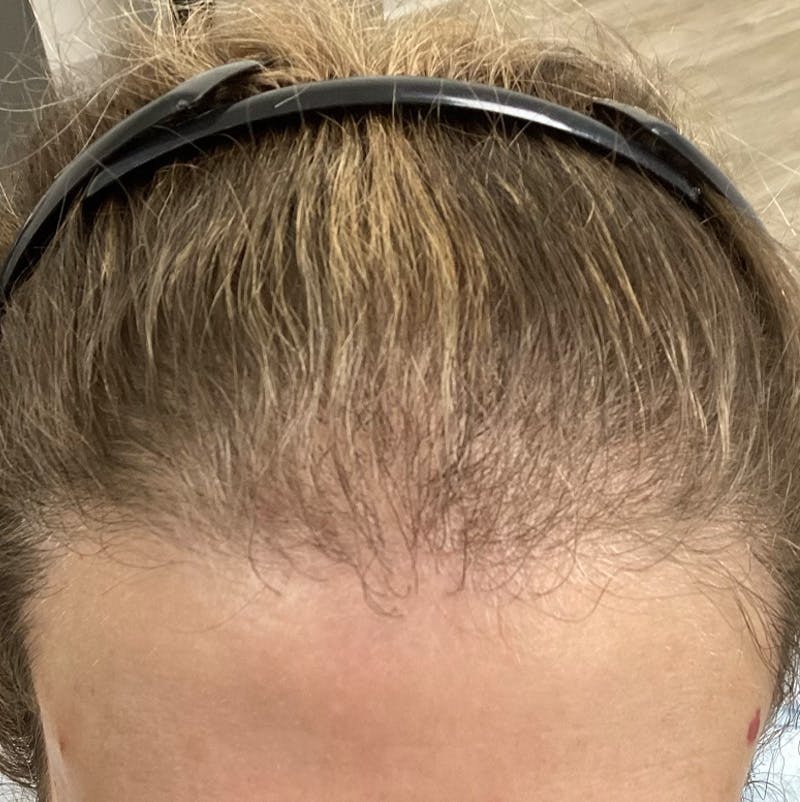 Androgenic Alopecia Before & After Gallery - Patient 168528 - Image 1