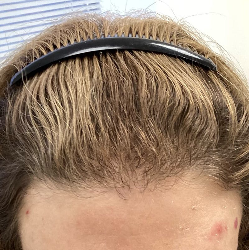 Androgenic Alopecia Before & After Gallery - Patient 168528 - Image 2
