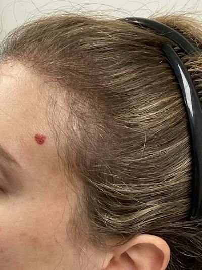 Androgenic Alopecia Before & After Gallery - Patient 619534 - Image 1