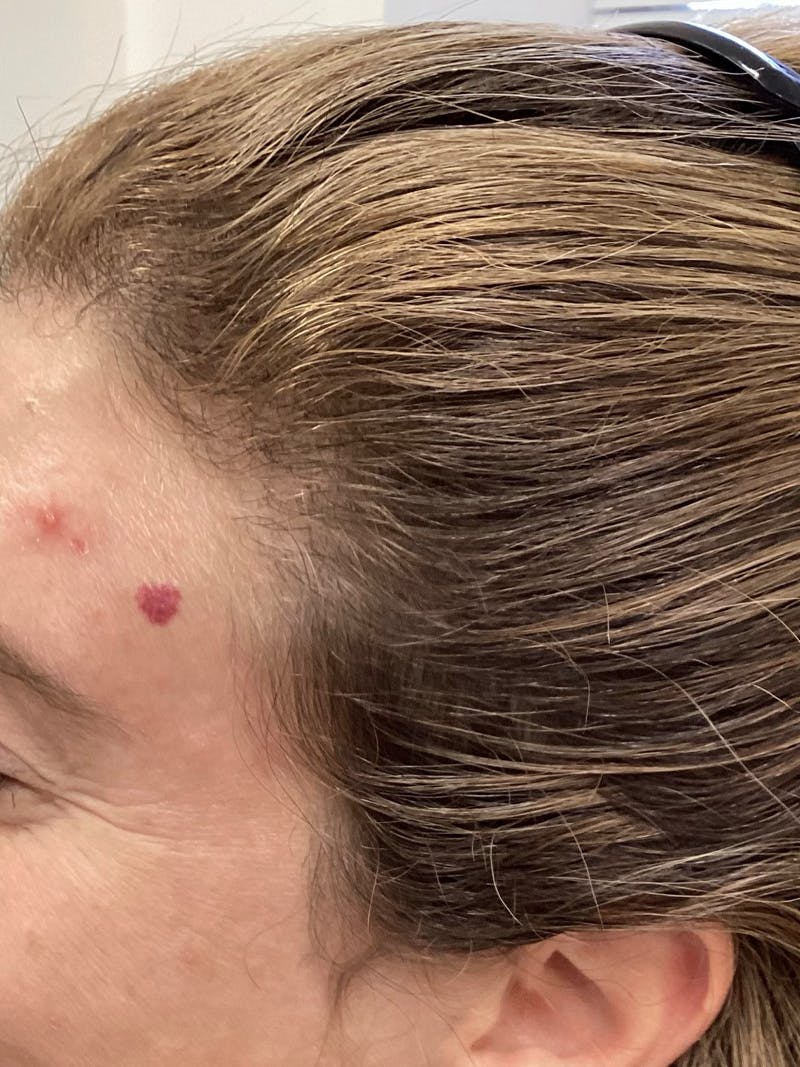 Androgenic Alopecia Before & After Gallery - Patient 619534 - Image 2