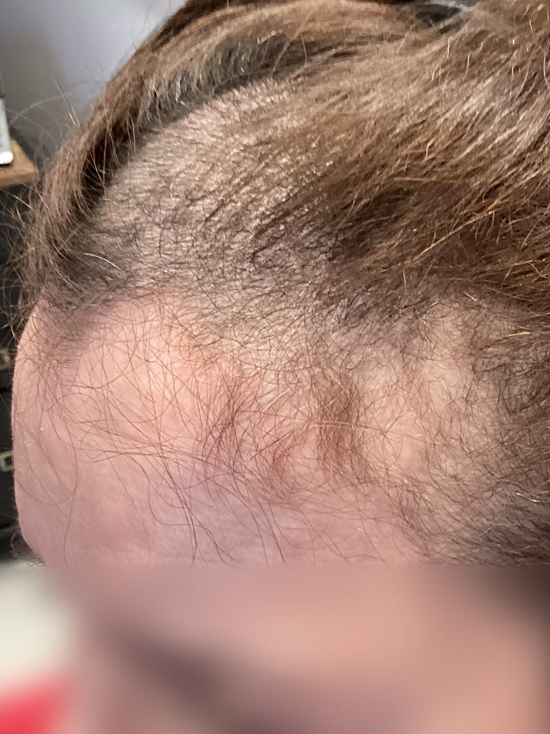 Telogen Effluvium Before & After Gallery - Patient 384076 - Image 1