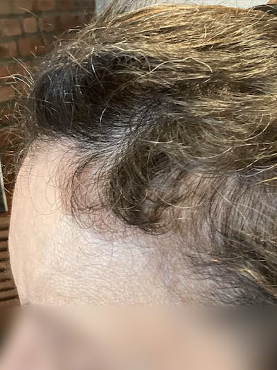 patient hair