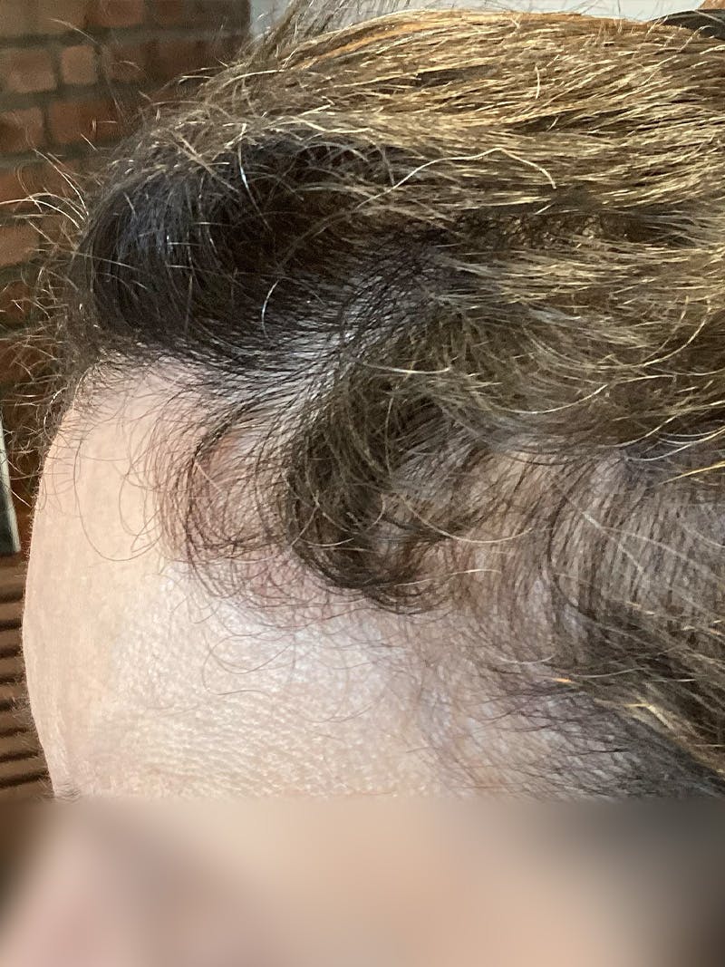 Telogen Effluvium Before & After Gallery - Patient 384076 - Image 2